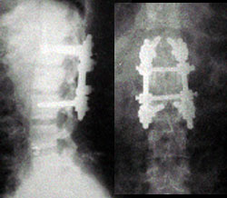 Spine