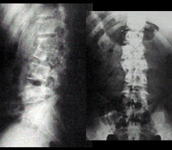 Spine