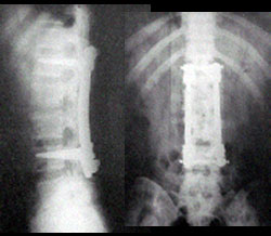 Spine